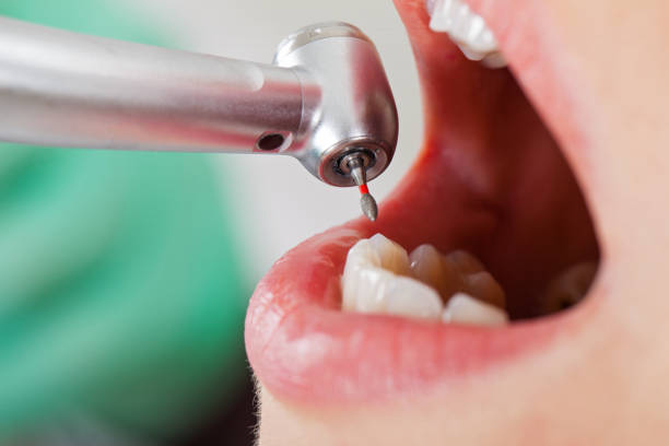 Best Emergency Tooth Extraction in Holmen, WI